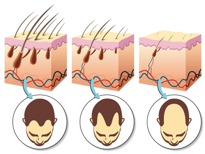 What You Need to Know About DHT and Hair Loss