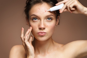 How to get rid of acne and pimples once and for all?